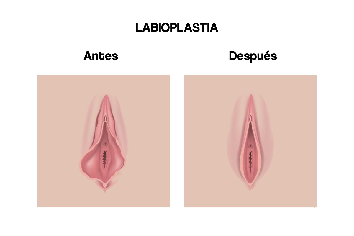 Cirugía íntima labioplastia