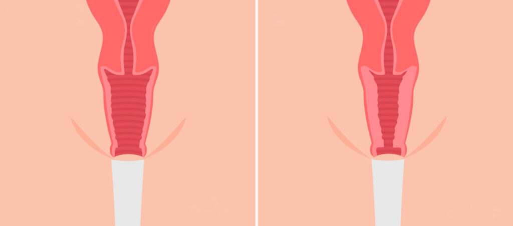 Vaginoplastia cirugia intima