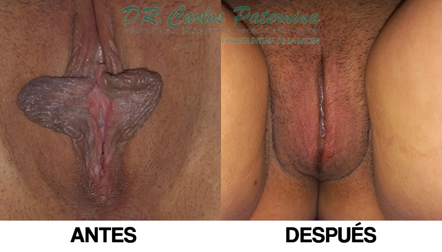 Cirugía de Rejuvenecimiento Vaginal Fotos Antes y Después