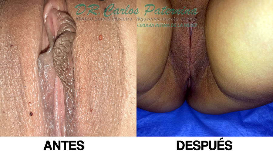 Cirugía de Rejuvenecimiento Vaginal Fotos Antes y Después 