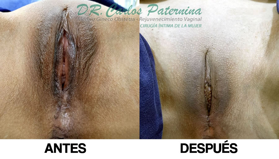 Labioplastia cirugia antes y después antes y despues